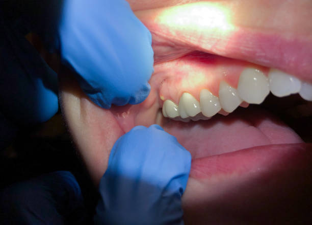 Best Emergency Dental Care for Abscessed Tooth in Freer, TX